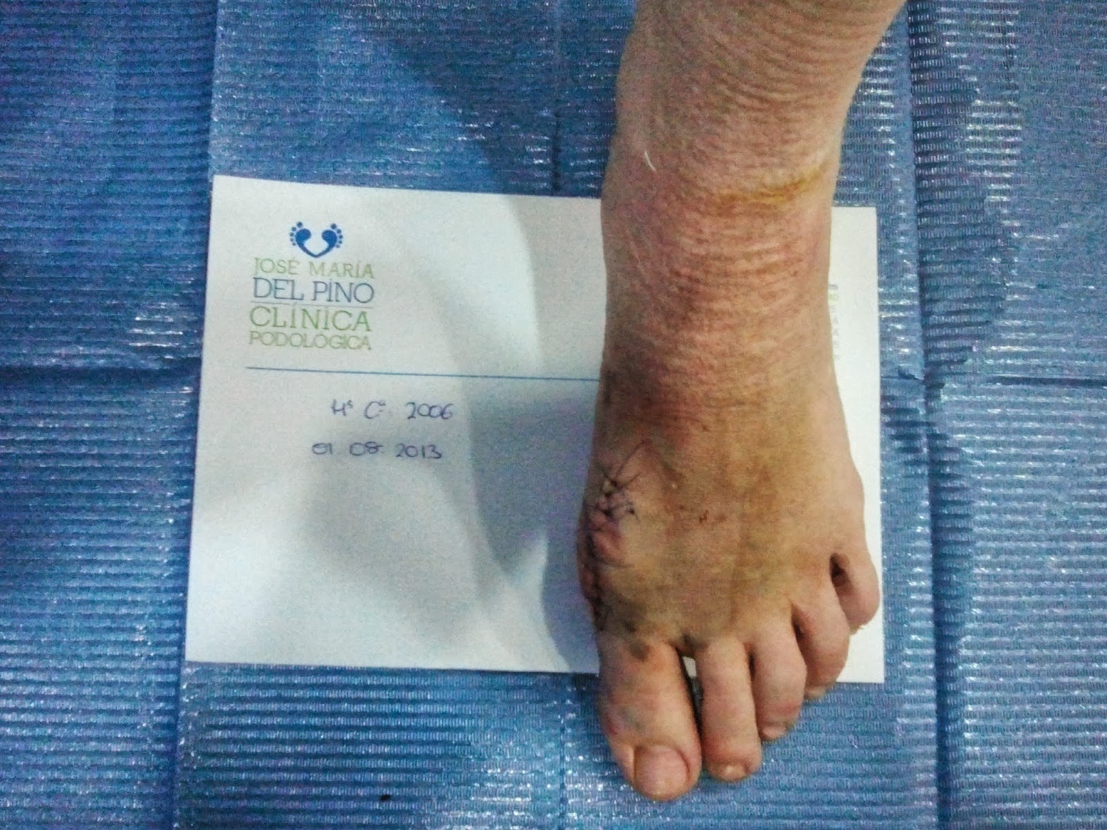Cirugia de juanetes con tornillos